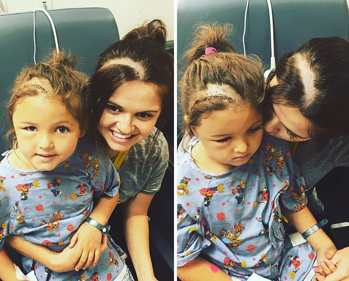 Kochająca mama ogoliła głowę, by wesprzeć swoją córeczkę po ciężkiej operacji mózgu.