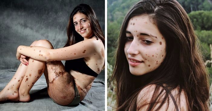 Nastolatka z ponad 500 znamionami na ciele – dawnej nękana przez rówieśników, dziś piękna jak nigdy!