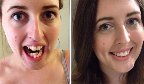 10 niewiarygodnych przemian, jakich doświadczyli ludzie, którzy zdecydowali się na aparat ortodontyczny.
