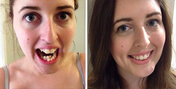 10 niewiarygodnych przemian, jakich doświadczyli ludzie, którzy zdecydowali się na aparat ortodontyczny.