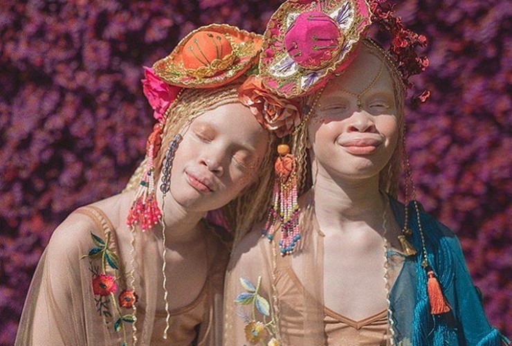 Rok temu nietypowe bliźniaczki podbiły internet, spójrz jak wyglądają teraz!