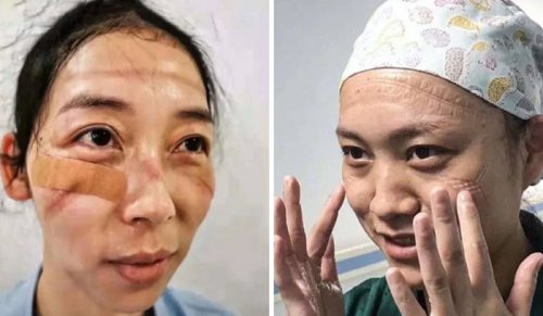 Chińskie pielęgniarki dzielą się zdjęciami swoich twarzy po niezliczonych godzinach walki z koronawirusem.