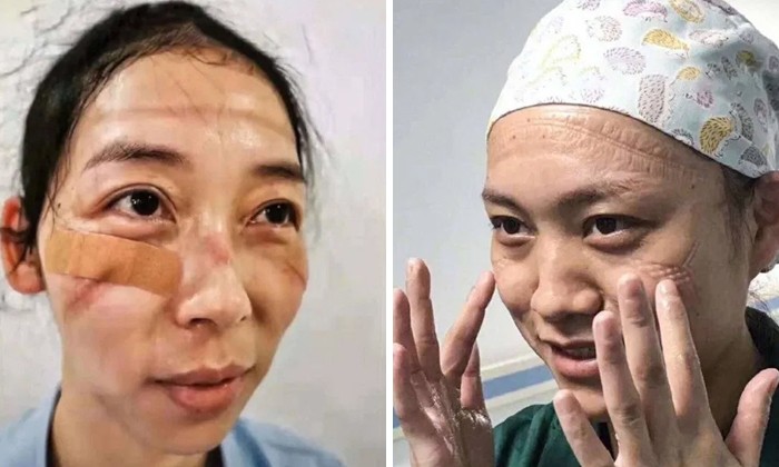 Chińskie pielęgniarki dzielą się zdjęciami swoich twarzy po niezliczonych godzinach walki z koronawirusem.
