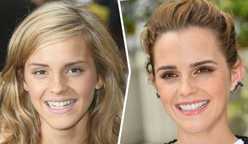 Oto jak zmieniły się uśmiechy 15 celebrytów po naprawieniu zębów!