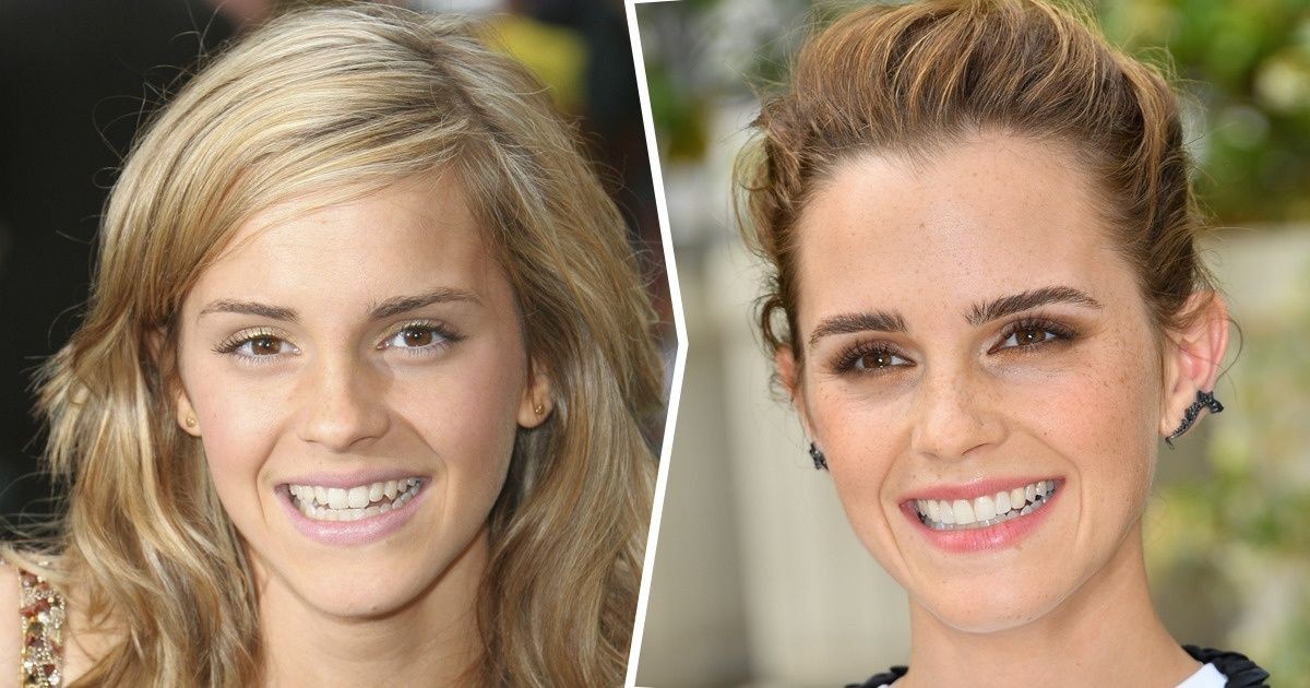 Oto jak zmieniły się uśmiechy 15 celebrytów po naprawieniu zębów!
