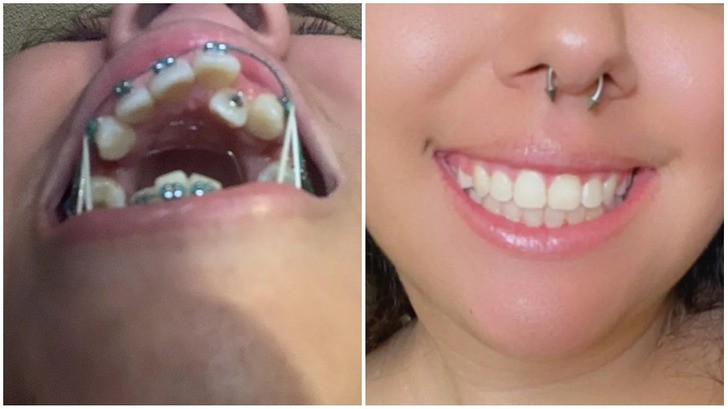 20 osób, które chcą chwalić się swoimi naprawionymi zębami!