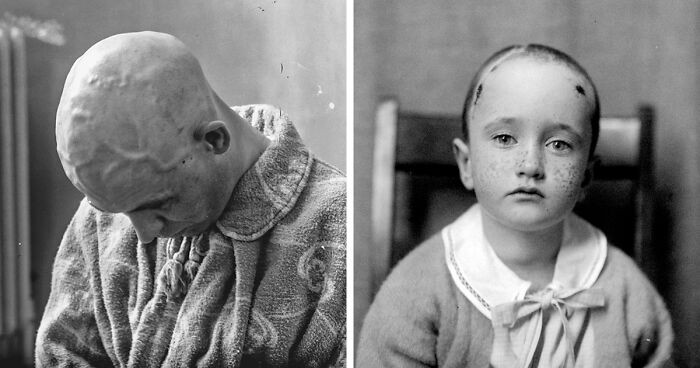 20 przerażających portretów medycznych pacjentów Harveya Cushinga na początku XX wieku!