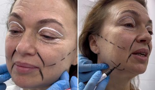 58-letnia kobieta ujawnia wyniki operacji liftingu twarzy, wprawiając wszystkich w zachwyt!