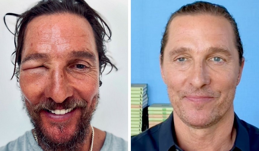 Matthew McConaughey zmartwił swoich fanów, publikując zdjęcie swojego opuchniętego oka!