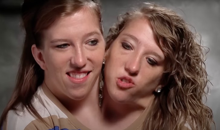 Bliźniaczki syjamskie, które płaciły podwójne czesne za studia, teraz zarabiają jedną pensję, wywołując debatę!