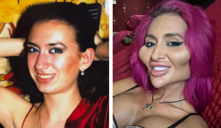 Kobieta z „największymi policzkami na świecie” pokazuje swoje rzadkie zdjęcie sprzed operacji!