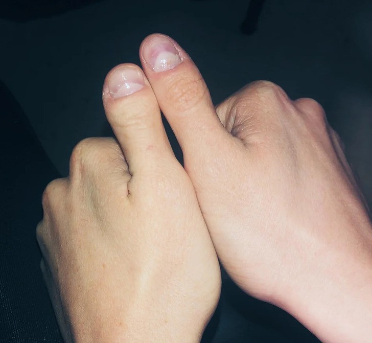 18 przypadków, kiedy genetyka dała ludziom coś naprawdę wyjątkowego!