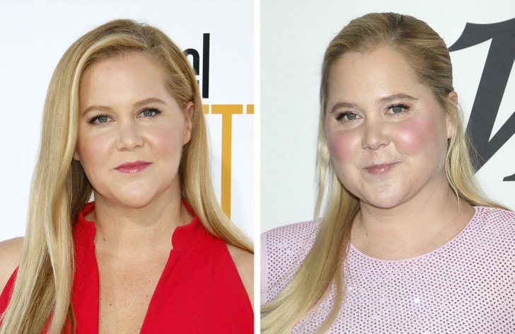 „Moon Face” – internauci pomogli Amy Schumer odkryć problem po ciąży!