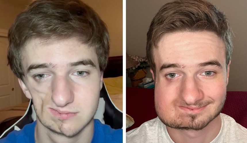 Rzadka choroba młodego mężczyzny uczyniła z niego niespodziewanego bohatera w sieci!