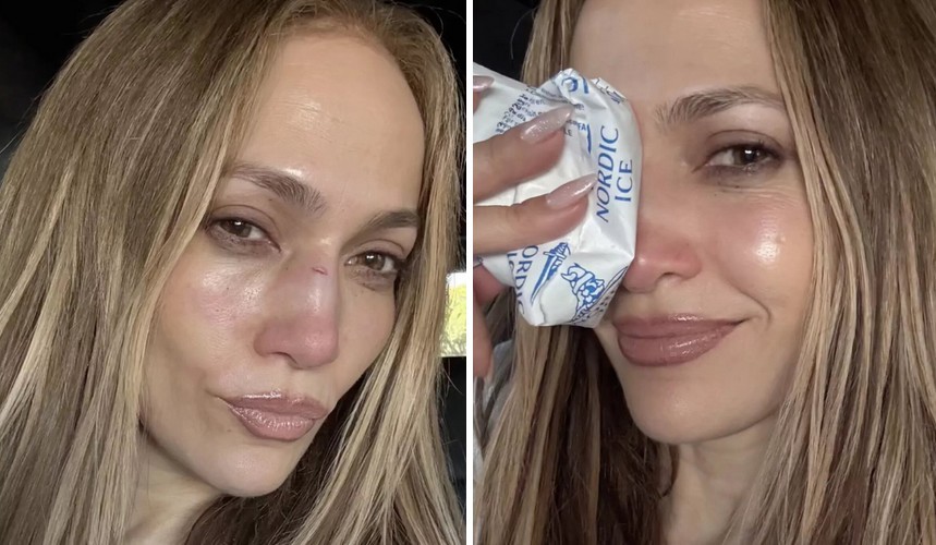 Jennifer Lopez publikuje w mediach społecznościowych zdjęcie rany na twarzy, szokując fanów!