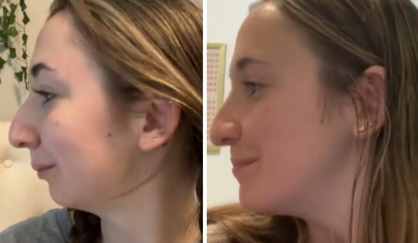 Transformacja młodej kobiety po operacji szczęki wywołuje ogromne reakcje!