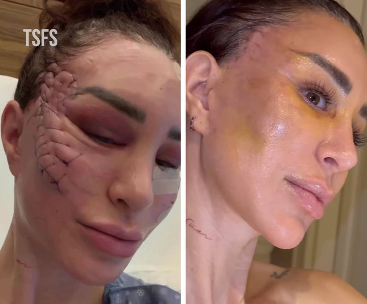 Kobieta zmienia twarz dzięki „niezwykłemu” liftingowi, wywołując debatę!