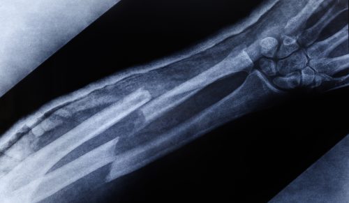 Teoria Niezłamanych Kości: TikTok, który zamienia przesądy w komedię