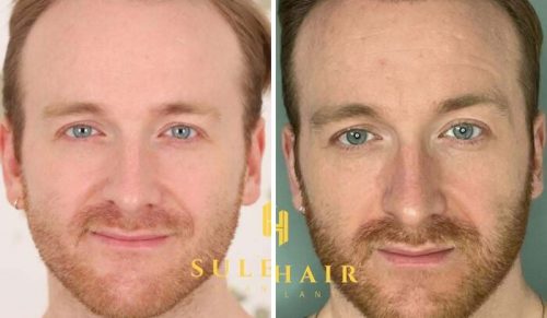 Chirurdzy pokazują efekty przeszczepu włosów na 81 zdjęciach przed i po