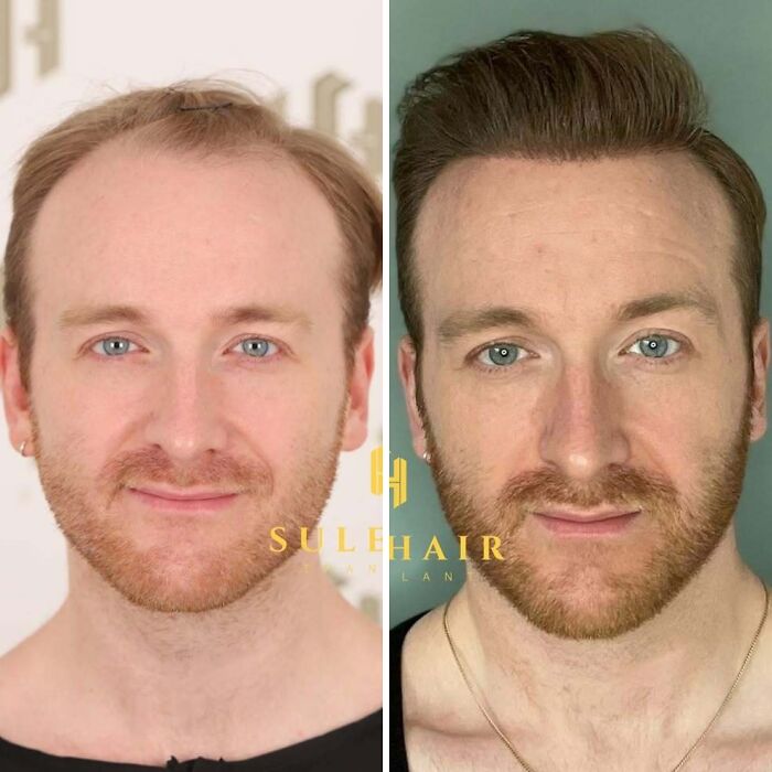 Chirurdzy pokazują efekty przeszczepu włosów na 81 zdjęciach przed i po