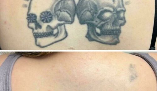 Zmieniło moje życie: zdjęcia przed i po usuwaniu tatuażu