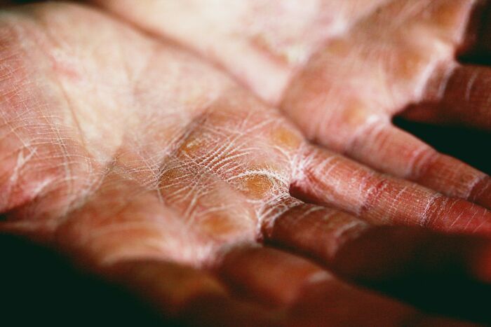 Close-up of dry, cracked hands. Evokes the unpleasantness of nightmare seatmate stories and a bad airline seating lottery.