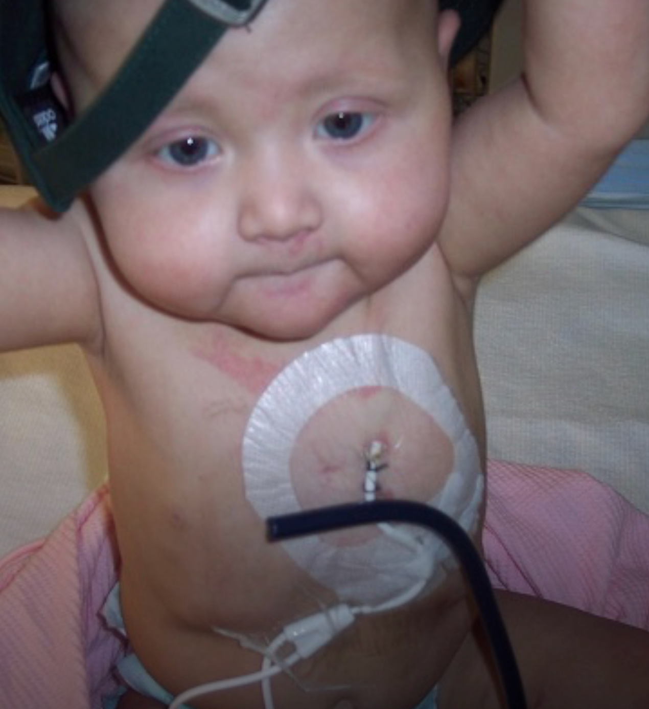 Baby with medical port on chest connected to leukemia treatment